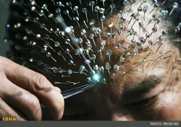(تصاویر) 2009 سوزن در صورت مرد چینی
