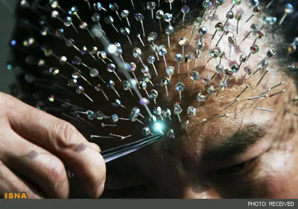 (تصاویر) 2009 سوزن در صورت مرد چینی
