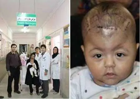 جراحی ترمیم جمجمه نوزادان به شیوه جدید
