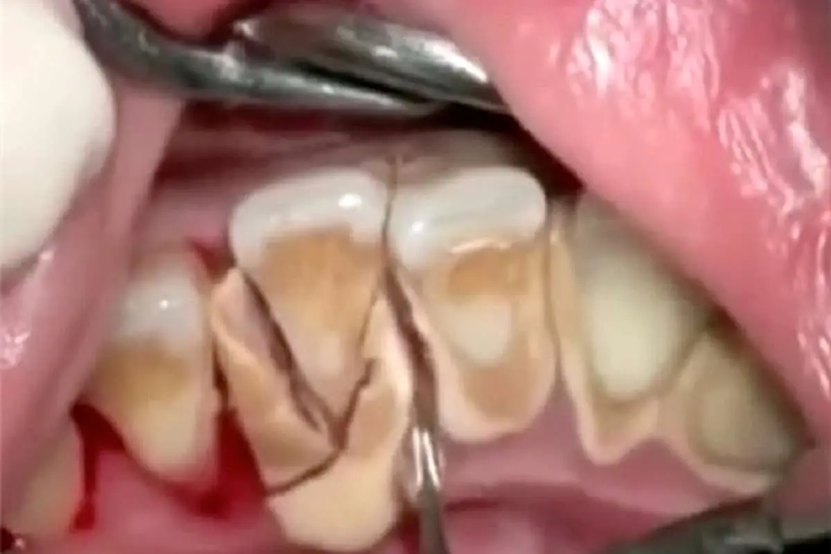 (تصویر) اثرات 10 سال مسواک نکردن دندانها