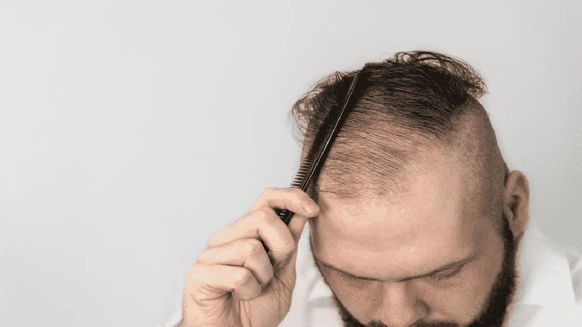 چرا بهبودیافتگان از کرونا دچار ریزش مو می‌شوند؟