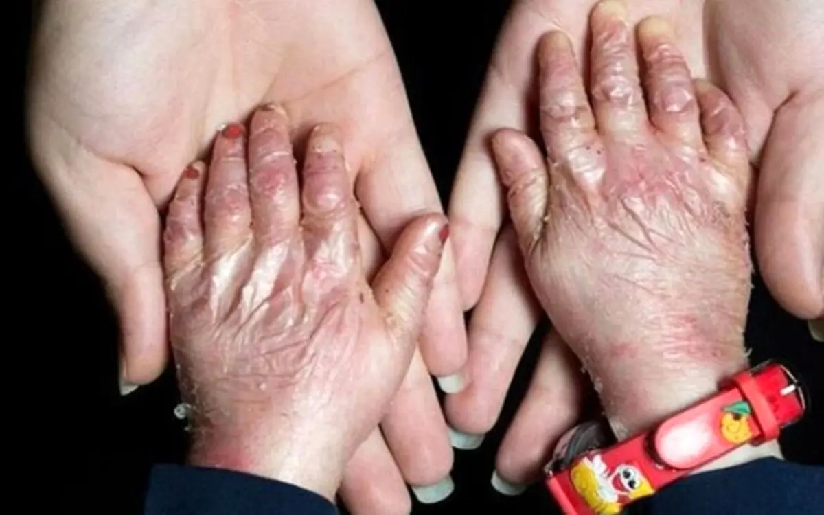 ماجرای گم شدن ۲۵۰۰ کیلو پانسمان بیماران پروانه‌ای