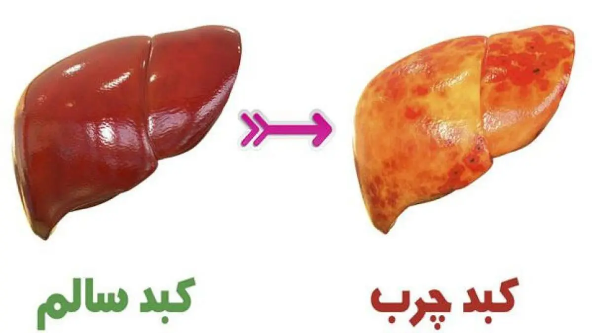 ۱۵ نشانه که می‌گوید کبدتان چرب است