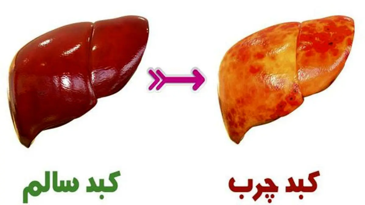 ۱۵ نشانه که می‌گوید کبدتان چرب است
