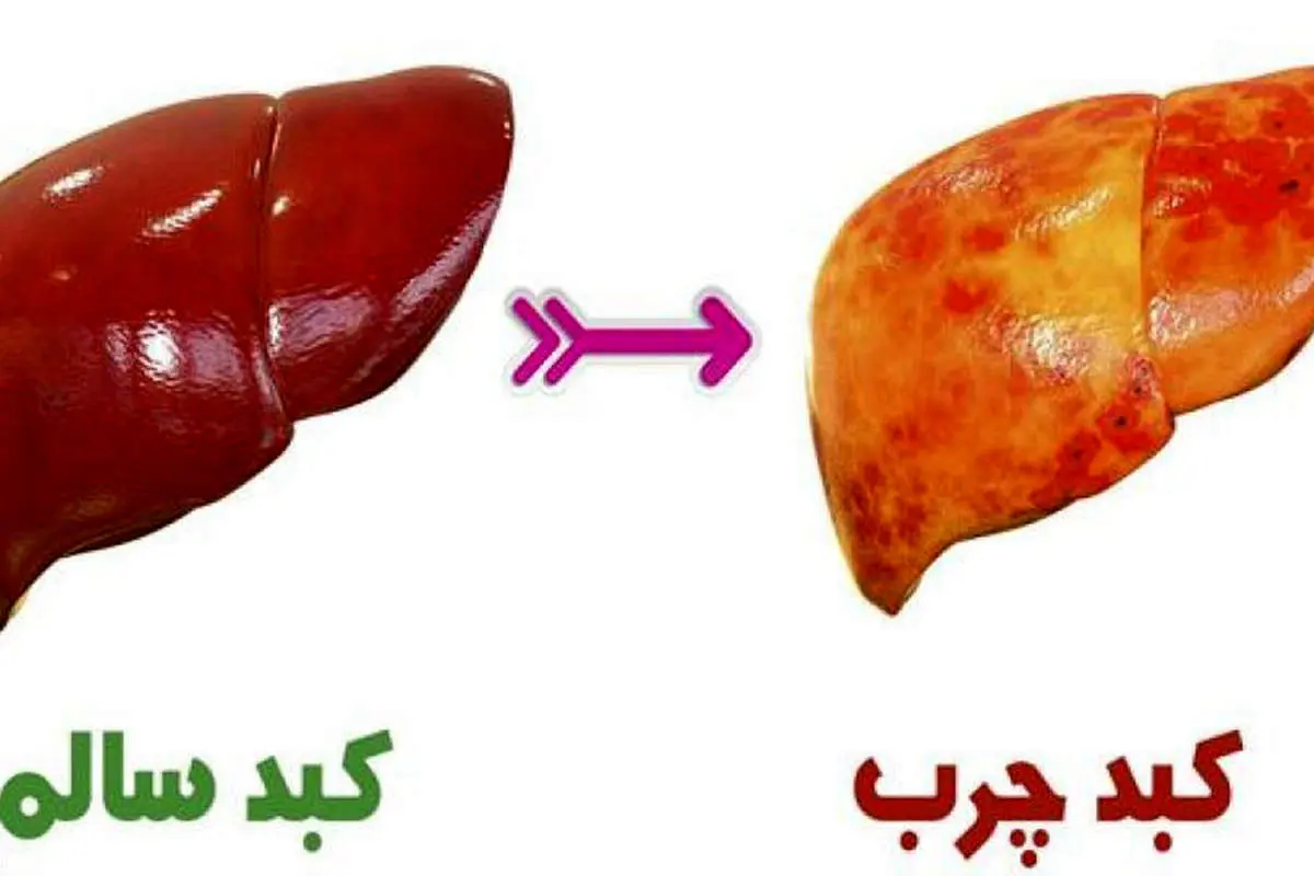 ۱۵ نشانه که می‌گوید کبدتان چرب است