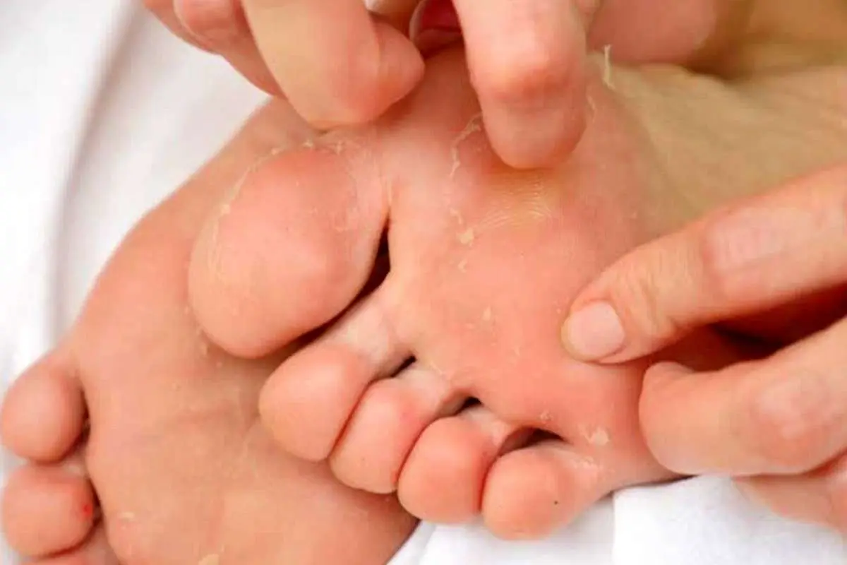 ۵ دلیل رایج پوسته پوسته شدن کف پا