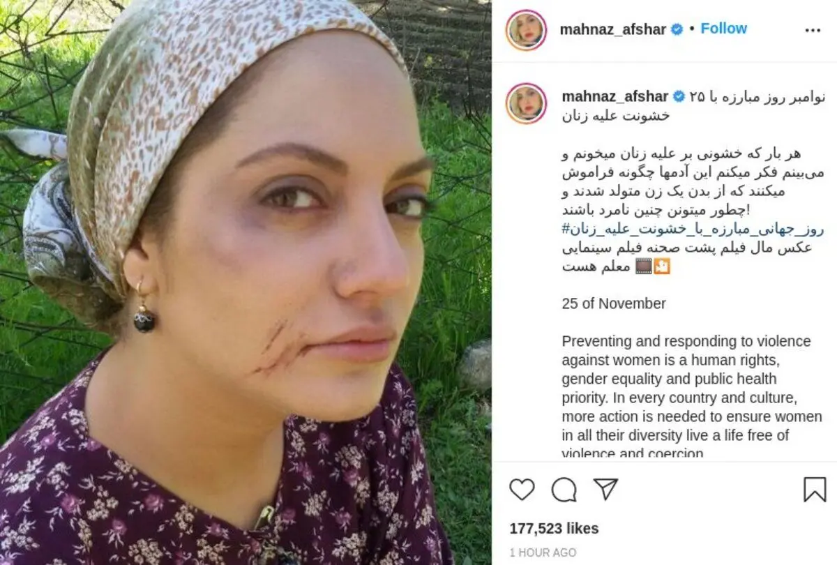 عکسی که مهناز افشار از صورت کبودش منتشر کرد