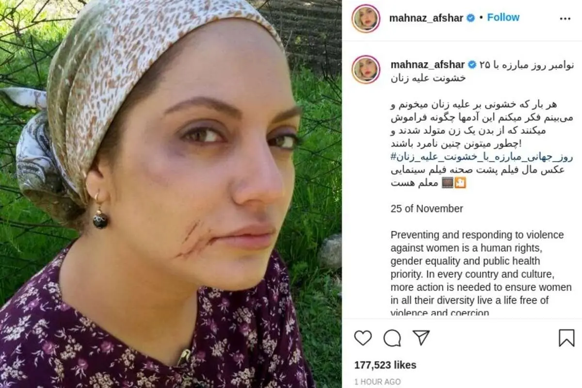 عکسی که مهناز افشار از صورت کبودش منتشر کرد