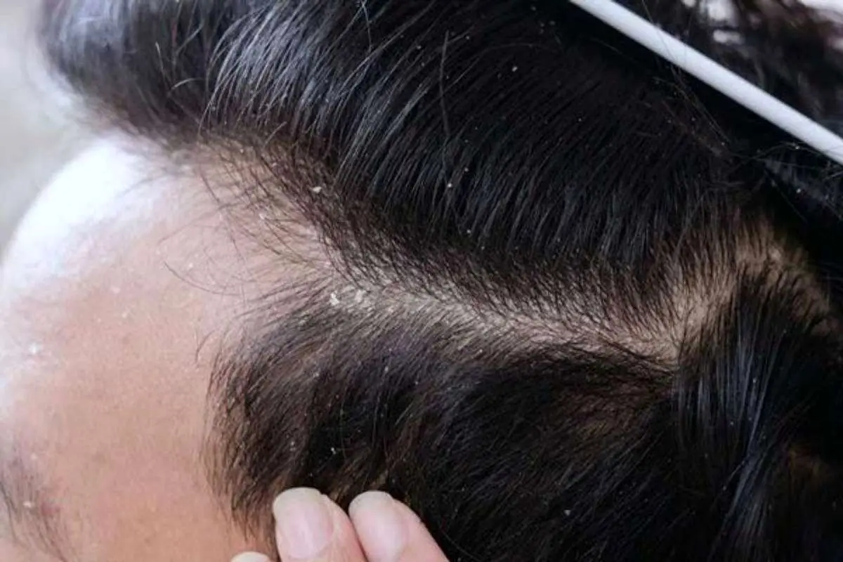 درمانهای خانگی سریع برای شوره سر