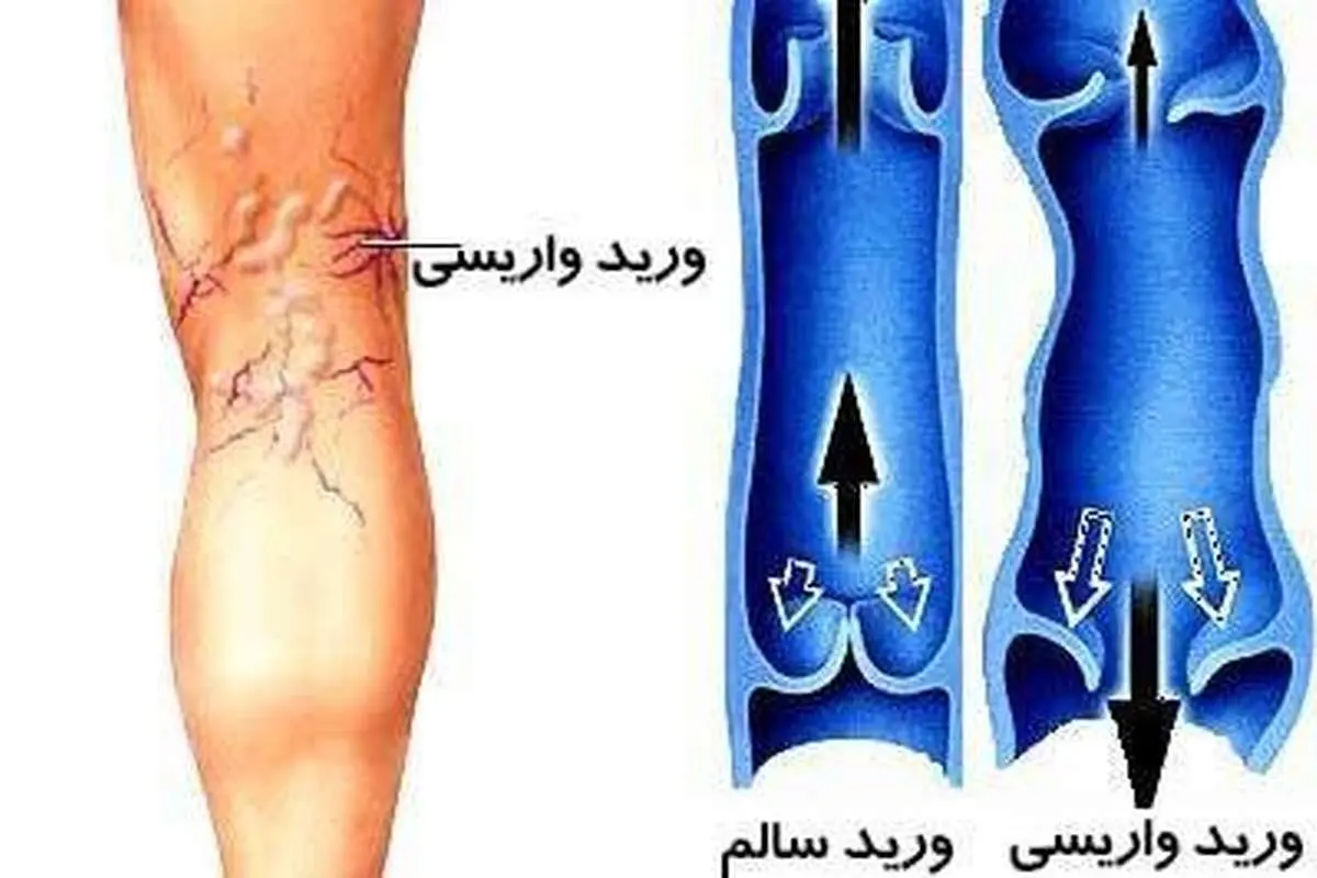 لباس تنگ و کفش پاشنه بلند یکی از علل بروز واریس در زنان