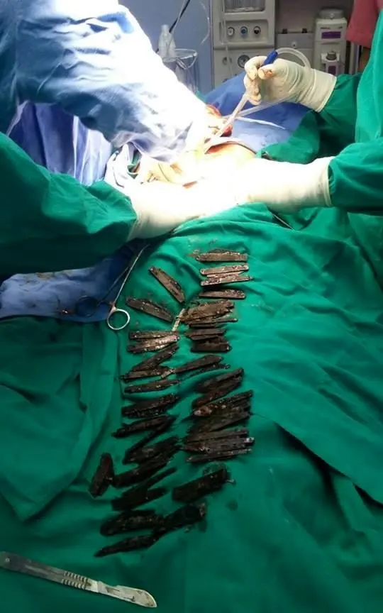 (تصاویر) چاقو در معده بیمار