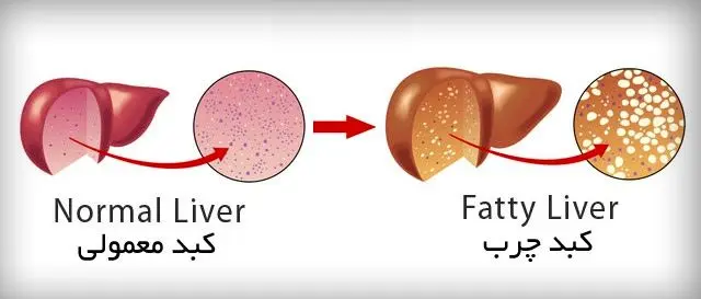 کبد چرب و توصیه‌های خانگی!