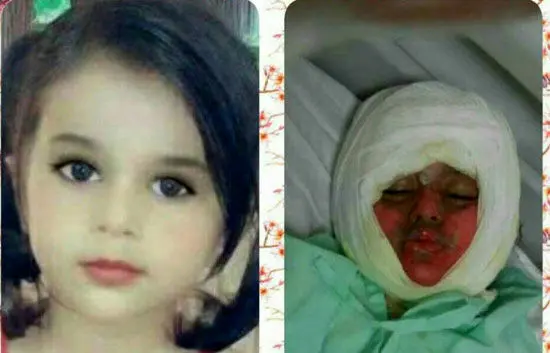 (عکس) کودک 3 ساله در دیگ غذای نذری سوخت!