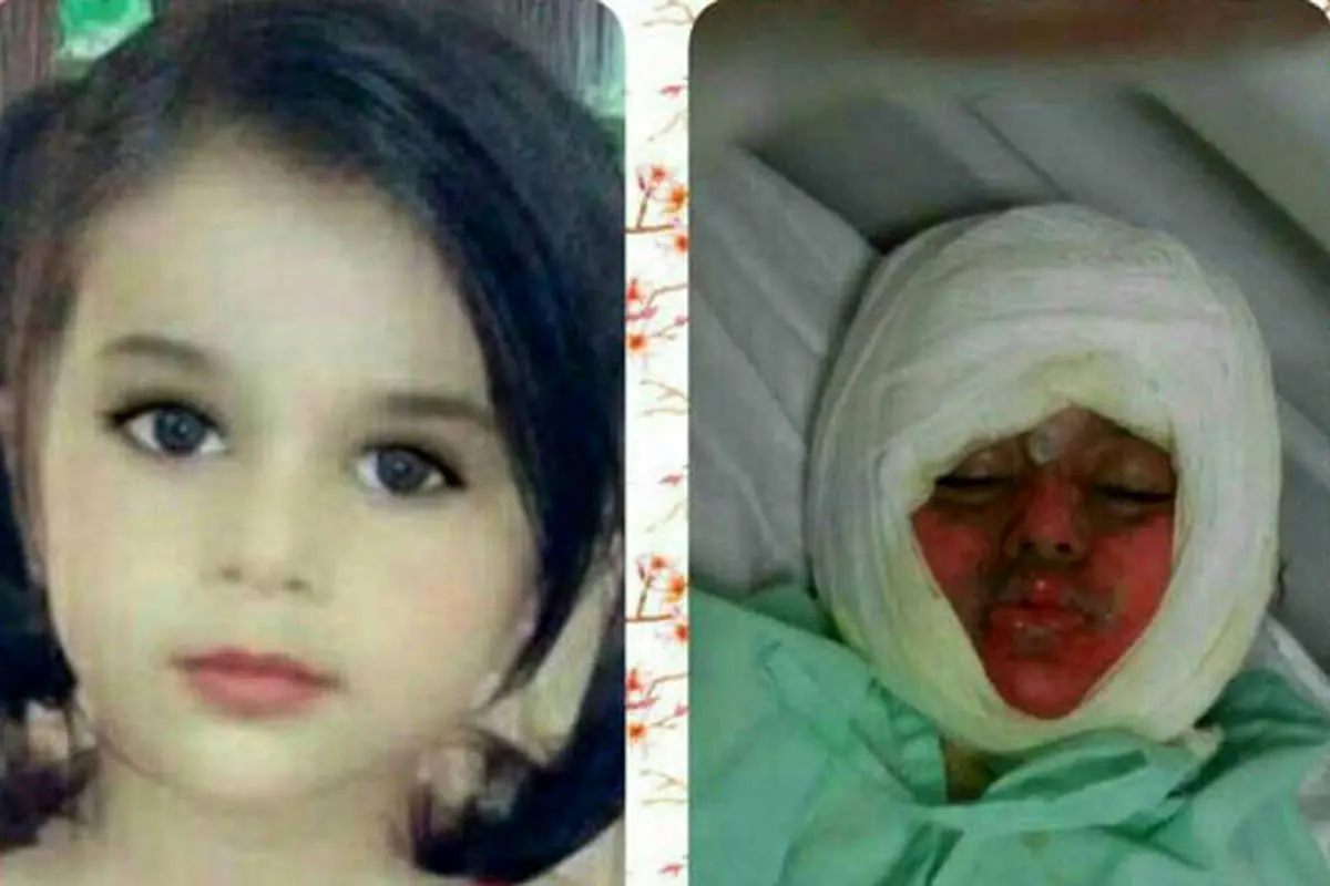 (عکس) کودک 3 ساله در دیگ غذای نذری سوخت!