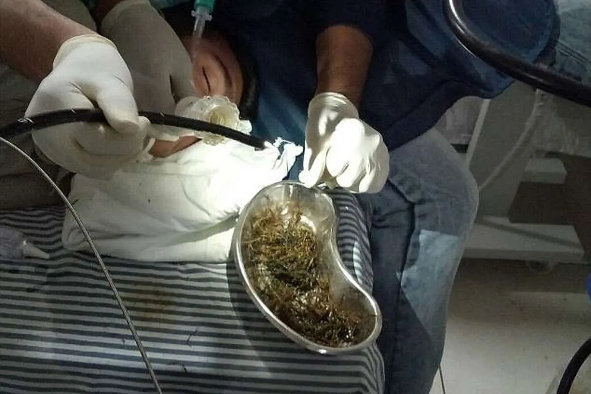 (تصویر) خارج کردن یک کیلو چوب از شکم یک نوجوان!