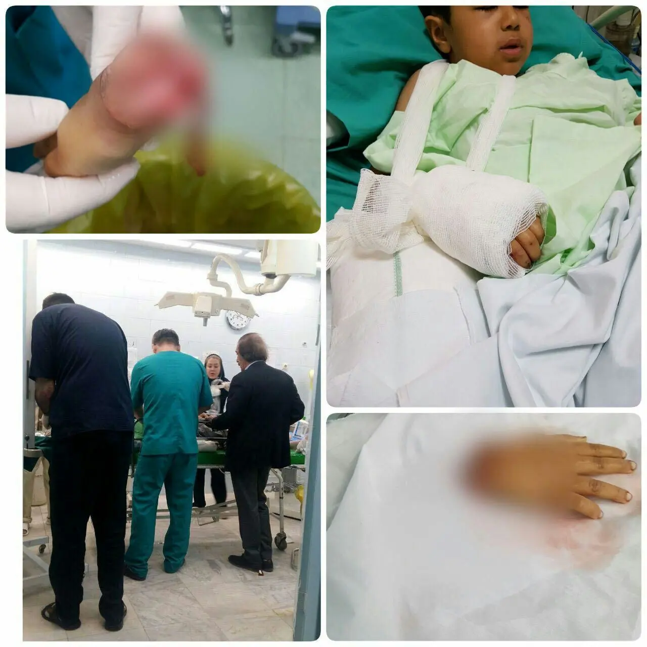 (عکس) پیوند دست قطع‌شده کودک زلزله‌زده