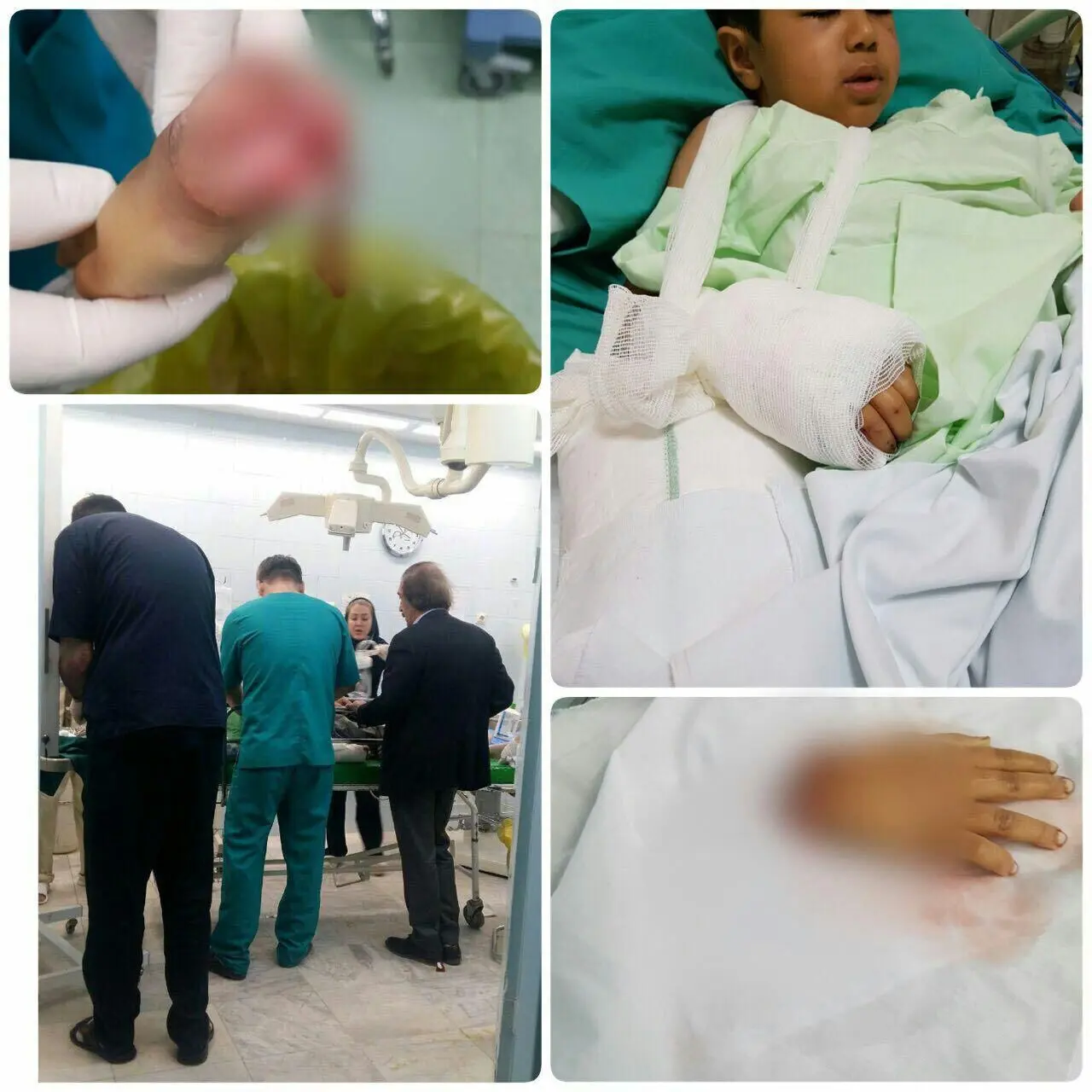 (عکس) پیوند دست قطع‌شده کودک زلزله‌زده