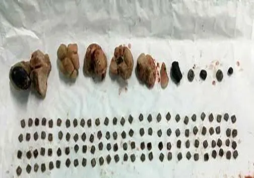 (تصویر) خروج بیش از ۱۵۰ تکه سنگ از کلیه یک بیمار!