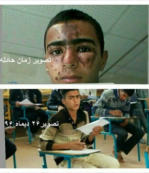 جزئیات حادثه سوختگی صورت دانش‌آموز زهکی