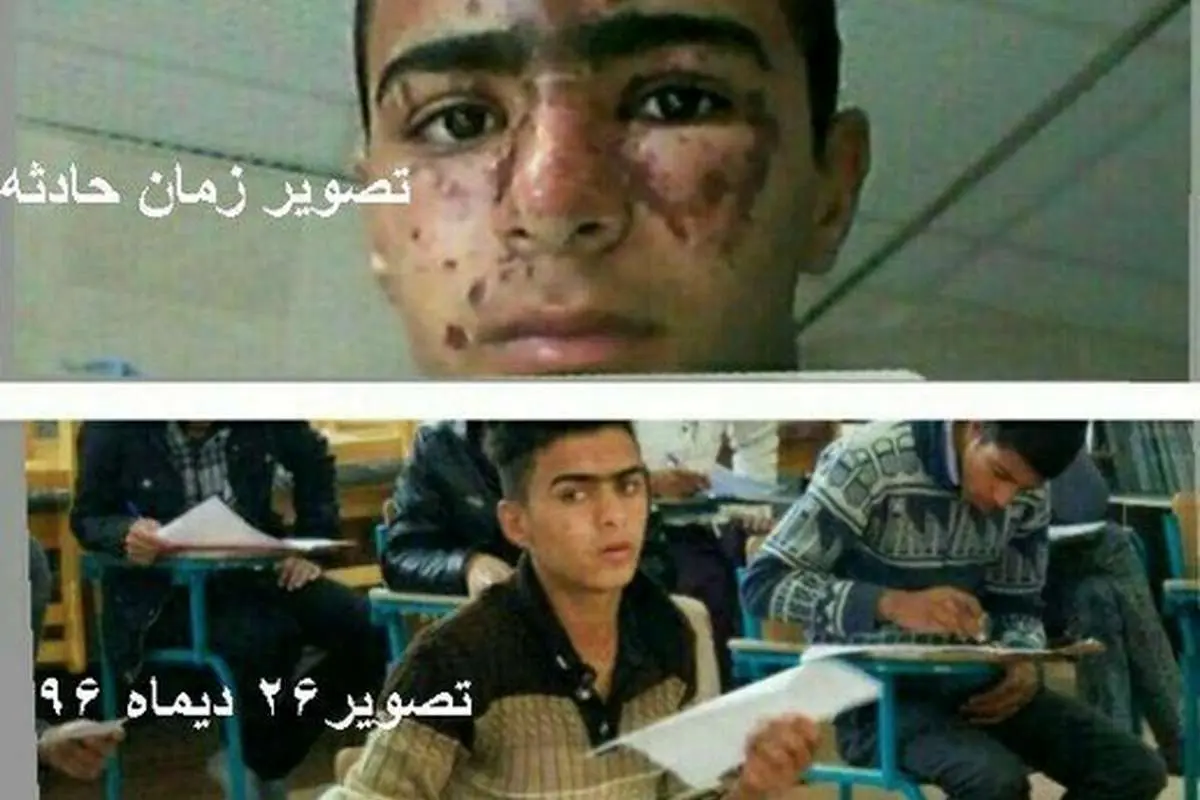 جزئیات حادثه سوختگی صورت دانشآموز زهکی