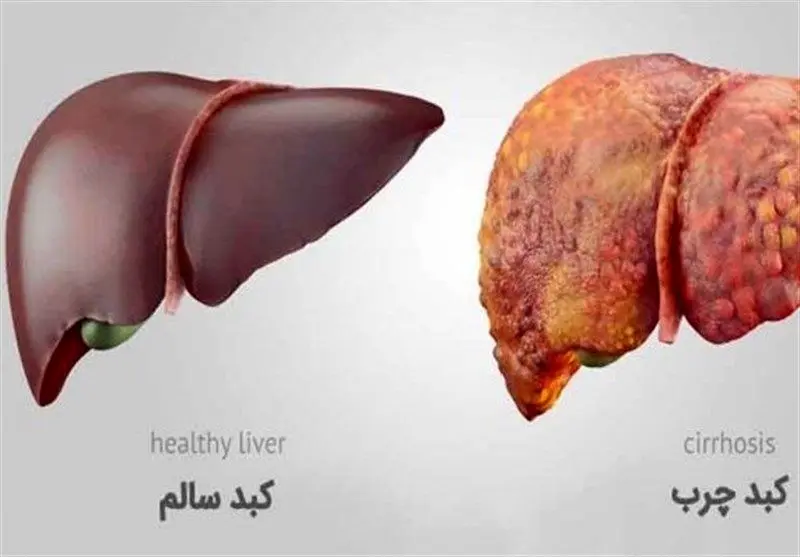 با داشتن این علائم به "کبد چرب" مبتلا هستید