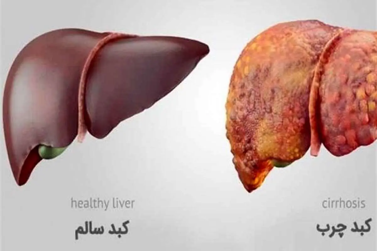 با داشتن این علائم به "کبد چرب" مبتلا هستید