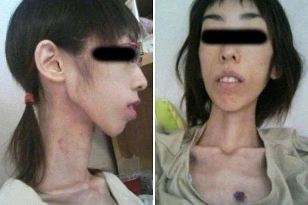 (تصاویر) شکنجه دختر جوان با ۱۷ کیلوگرم وزن!