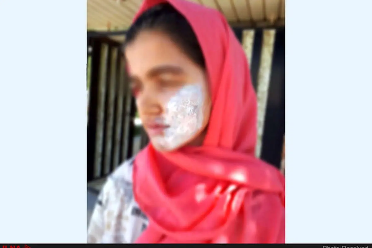نامادریام صورت و دستم را با اتوی داغ سوزاند!
