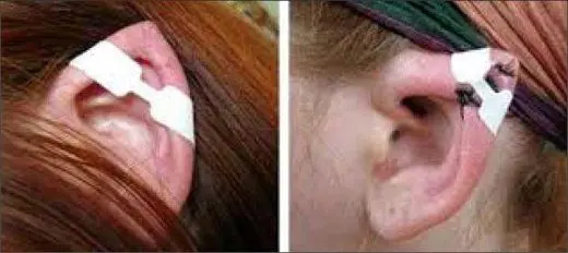 ماجرای جراحی زیبایی "گوش الاغی" به وزارت بهداشت رسید