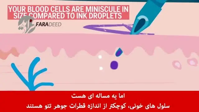 (ویدیو) دردسر بزرگ؛ تتو چگونه پاک می‌شود؟