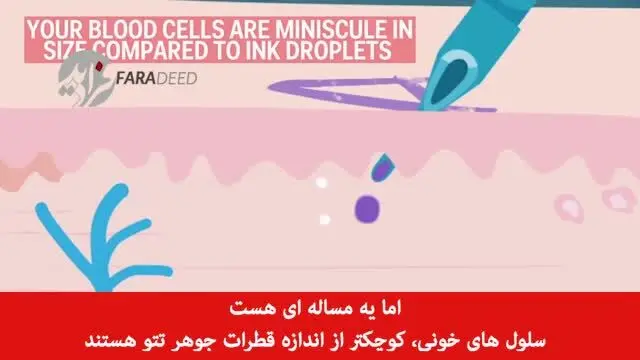 (ویدیو) دردسر بزرگ؛ تتو چگونه پاک می‌شود؟