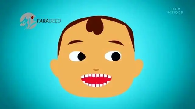 (ویدیو) دندان عقل چیست و چرا باید آن را کشید؟