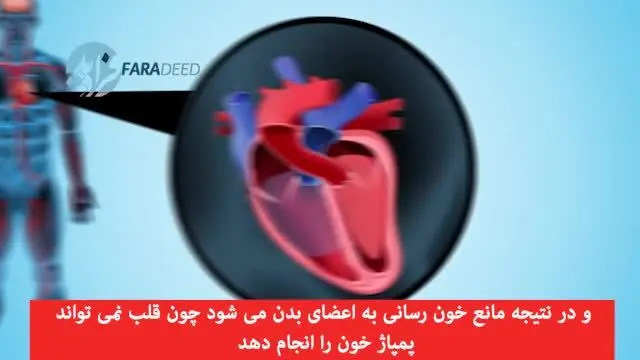 (ویدئو) با ایست قلبی چه اتفاقی رخ می‌دهد؟