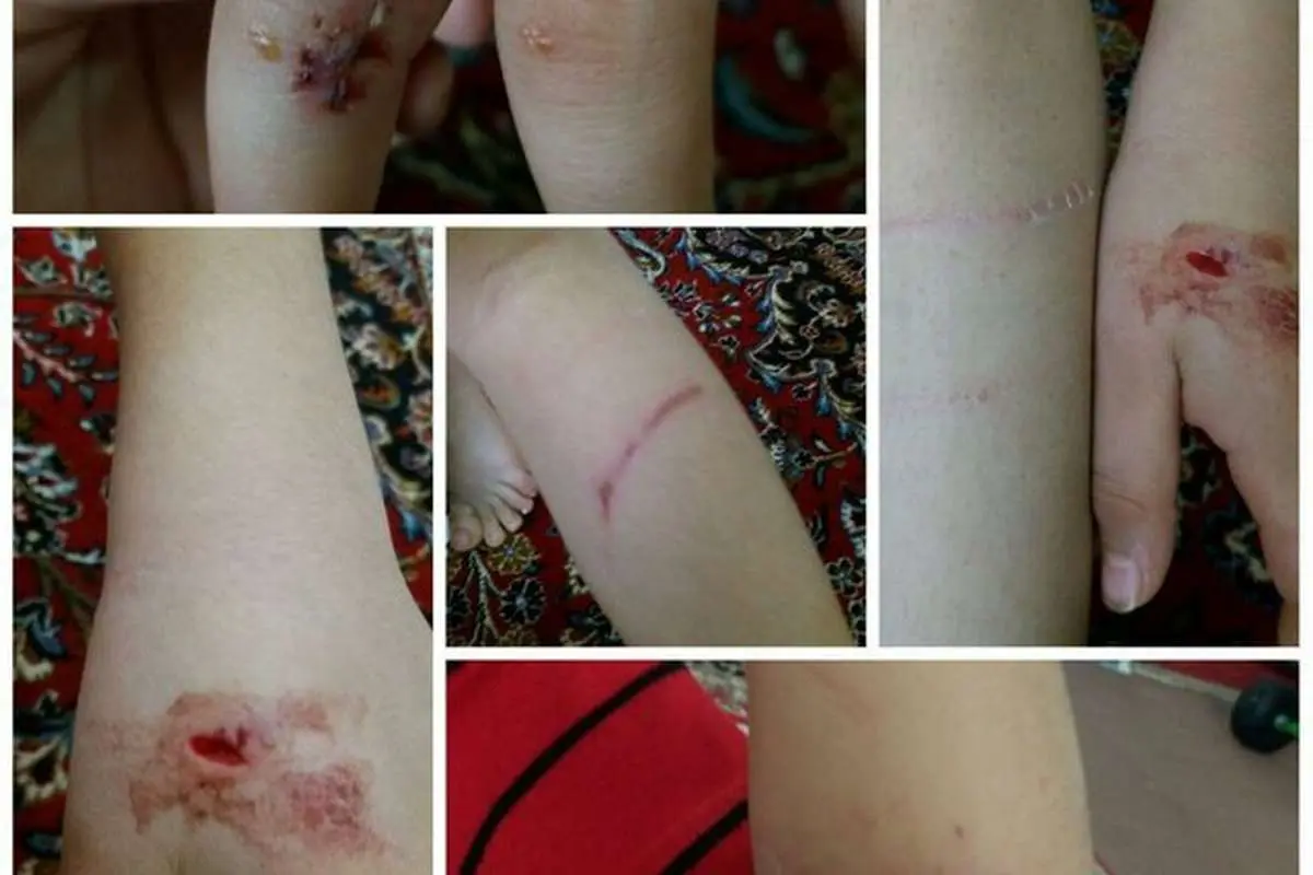 (تصویر) حمله سگ ولگرد به یک کودک ۷ ساله در یک روستا