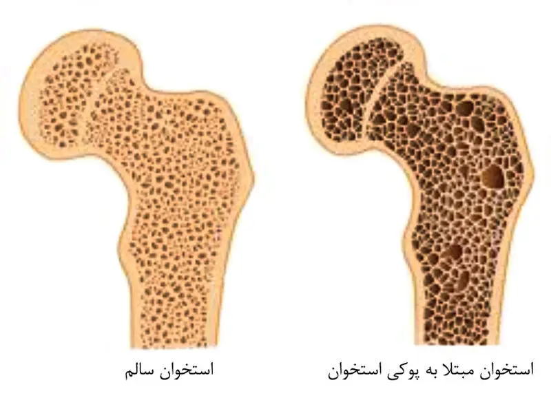 پوکی استخوان 1