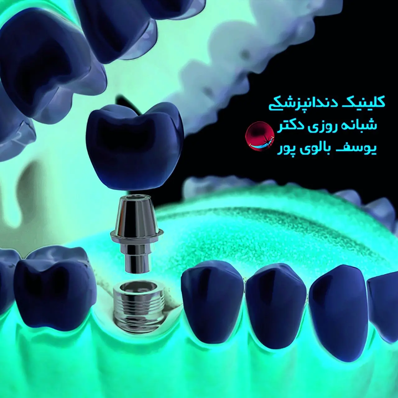 همه چیز درباره ی ایمپلنت و کامپوزیت دندان