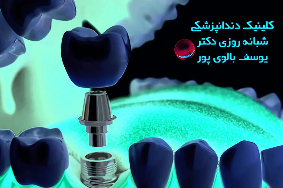 همه چیز درباره ی ایمپلنت و کامپوزیت دندان