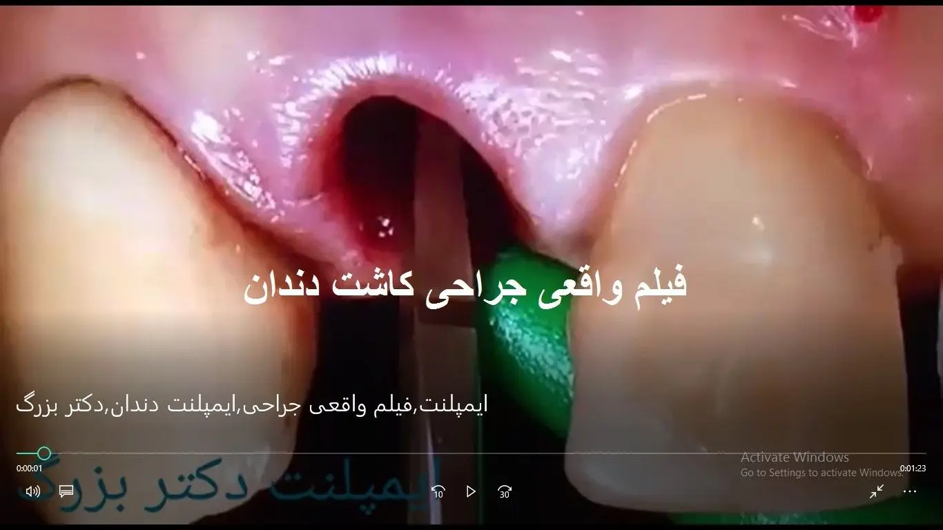 ایمپلنت دندان چقدر عمر میکند؟