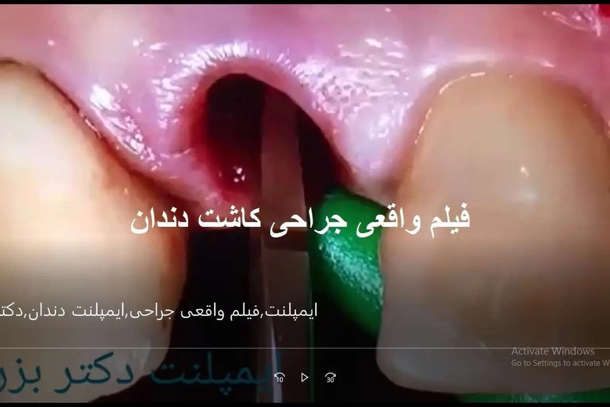 ایمپلنت دندان چقدر عمر میکند؟