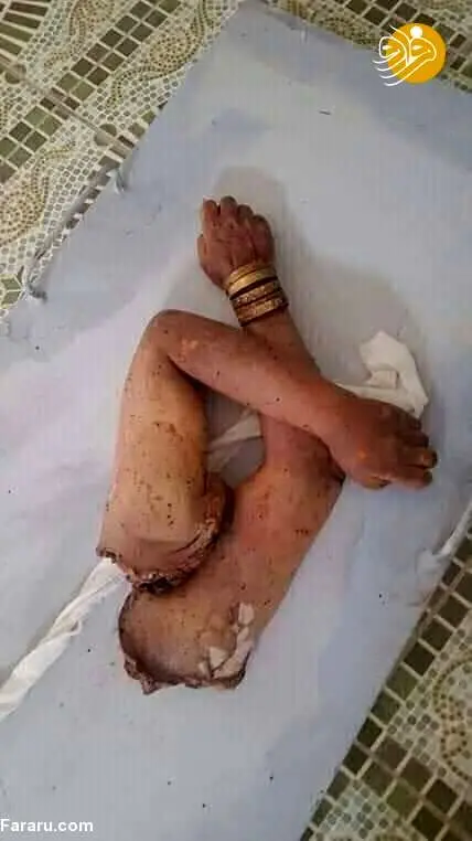 (تصویر +16) عکس غم‌انگیز از دست‌های قطع شده یک زن بر اثر انفجار کابل