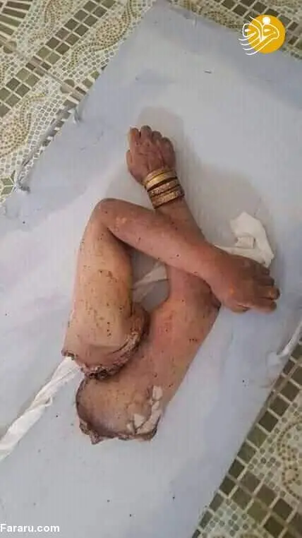 (تصویر +16) عکس غم‌انگیز از دست‌های قطع شده یک زن بر اثر انفجار کابل