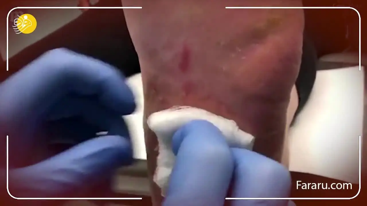 (ویدئو +۱۶) سوراخ ایجاد شده در پای یک بیمار مبتلا به دیابت