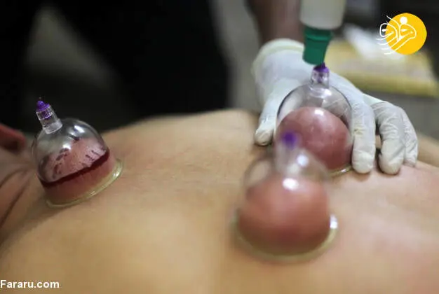 (تصاویر) حجامت در غزه