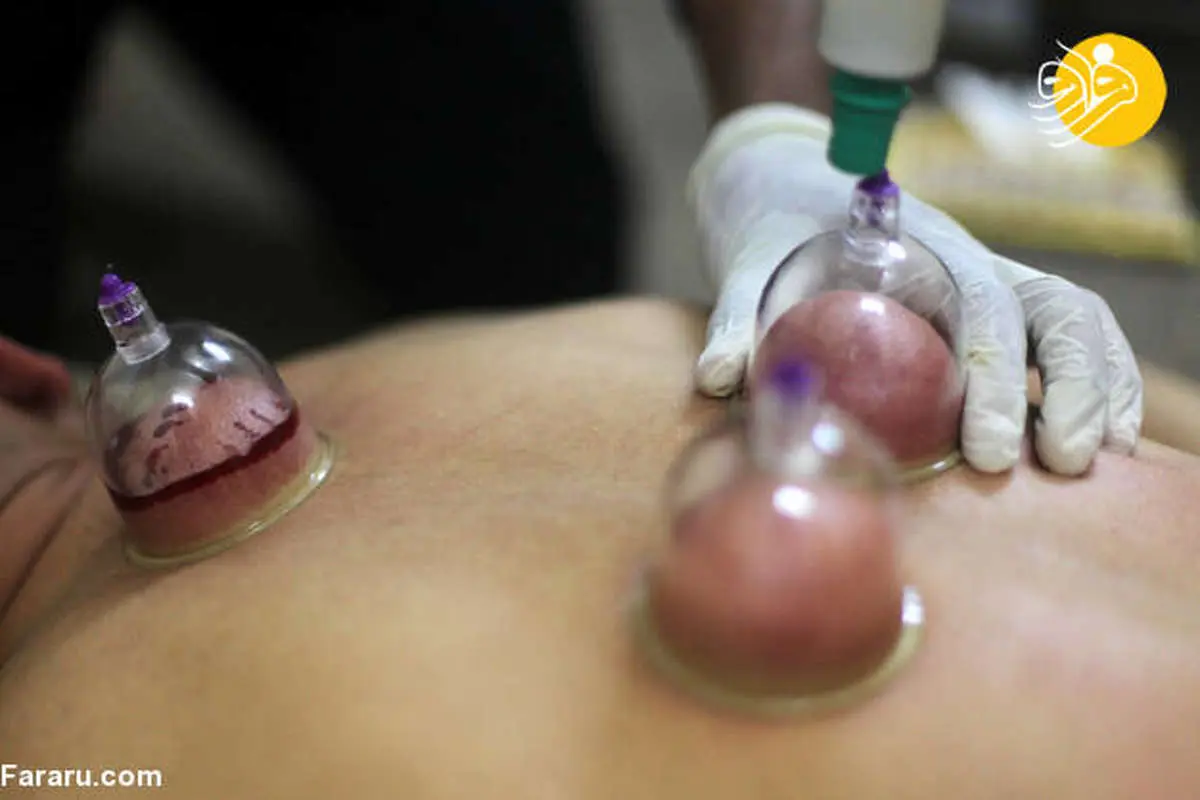 (تصاویر) حجامت در غزه