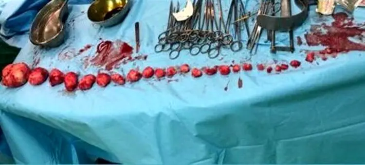 خارج کردن ۲۷ توده از رحم زن ۳۹ ساله بندرعباسی