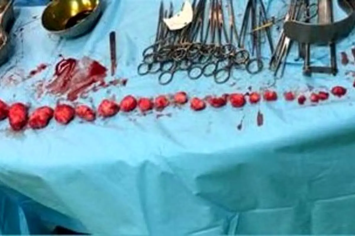 خارج کردن ۲۷ توده از رحم زن ۳۹ ساله بندرعباسی