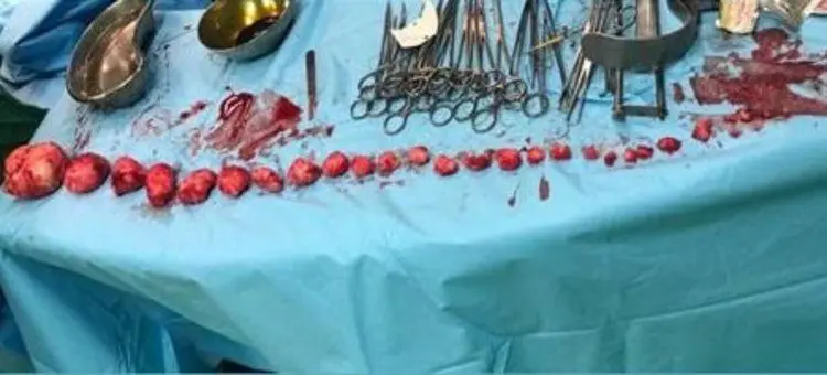 خارج کردن ۲۷ توده از رحم زن ۳۹ ساله بندرعباسی
