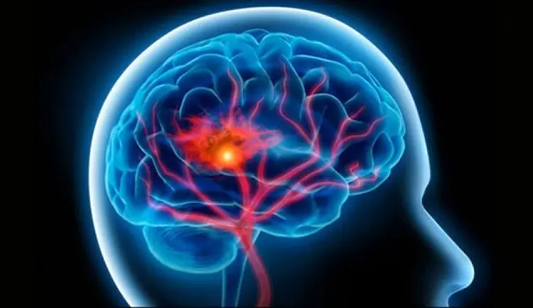 هشدار درباره افزایش سکته مغزی؛ علائم سکته مغزی چیست؟