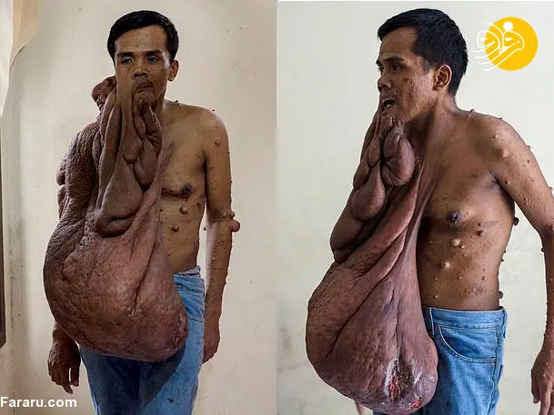 (تصاویر +16) زندگی دردناک با تومور ۴۰ کیلویی روی صورت و بدن