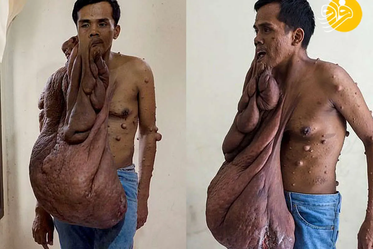 (تصاویر +16) زندگی دردناک با تومور ۴۰ کیلویی روی صورت و بدن
